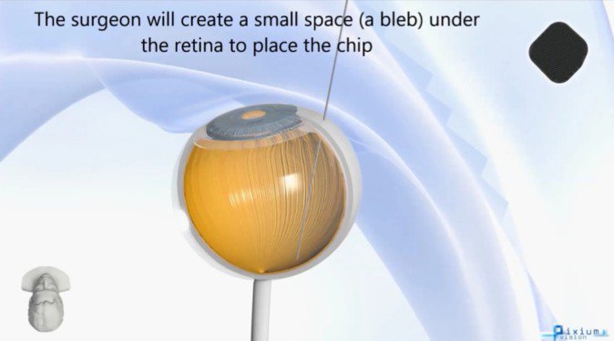 ARグラスと小型でワイヤレスの光電池式網膜下インプラントを組み合わせた「primaシステム」